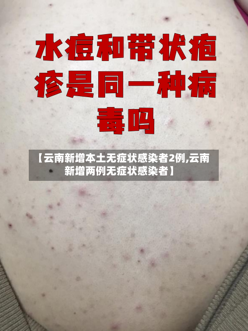 【云南新增本土无症状感染者2例,云南新增两例无症状感染者】-第2张图片