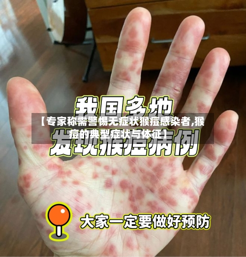 【专家称需警惕无症状猴痘感染者,猴痘的典型症状与体征】-第3张图片
