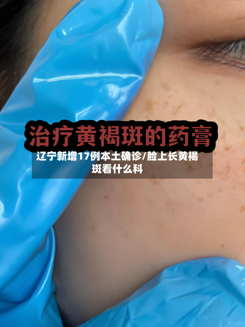 辽宁新增17例本土确诊/脸上长黄褐斑看什么科