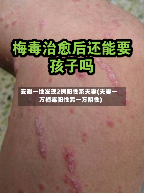 安徽一地发现2例阳性系夫妻(夫妻一方梅毒阳性另一方阴性)-第3张图片