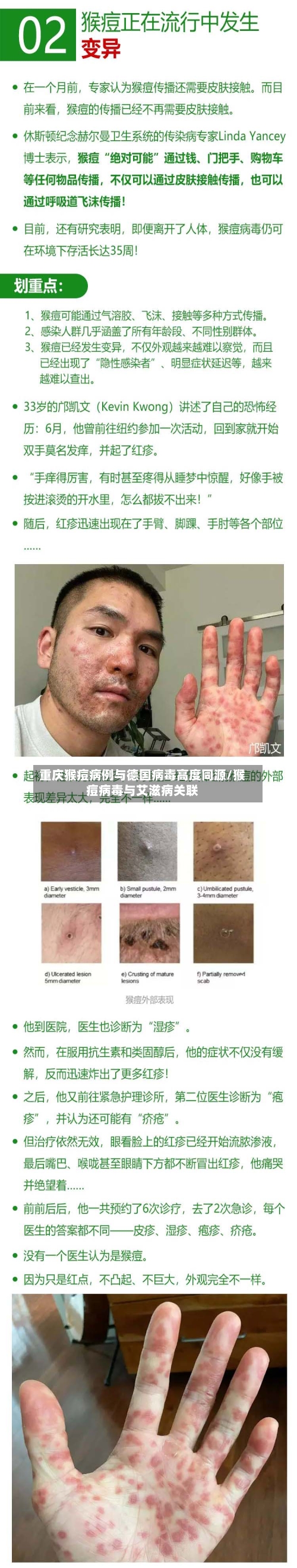 重庆猴痘病例与德国病毒高度同源/猴痘病毒与艾滋病关联